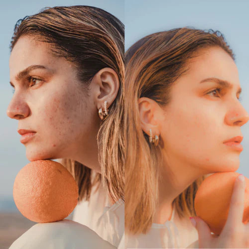 Red Light Therapy for Acne Scars: How It Works and How to Use It Safely