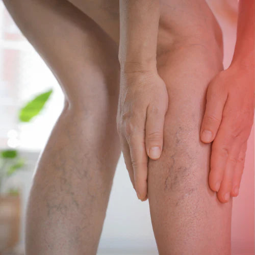 Red Light Therapy for Varicose Veins: Benefits, Safety & Results