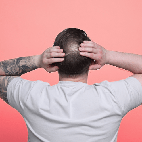 Maximize Your Health Goals: The Benefits of Red Light Therapy for Bald Spots at the Crown - Lumaflex